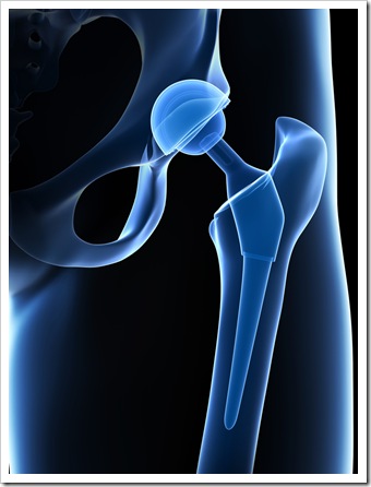 Back Pain Albuquerque NM Joint Replacement
