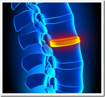 Herniated Disc and Back Pain Albuquerque NM