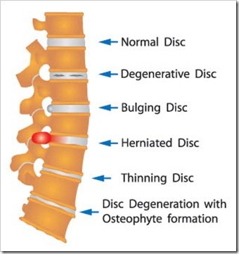 Back Pain Albuquerque NM Arthritis