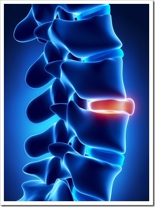 Slipped Disc Albuquerque NM